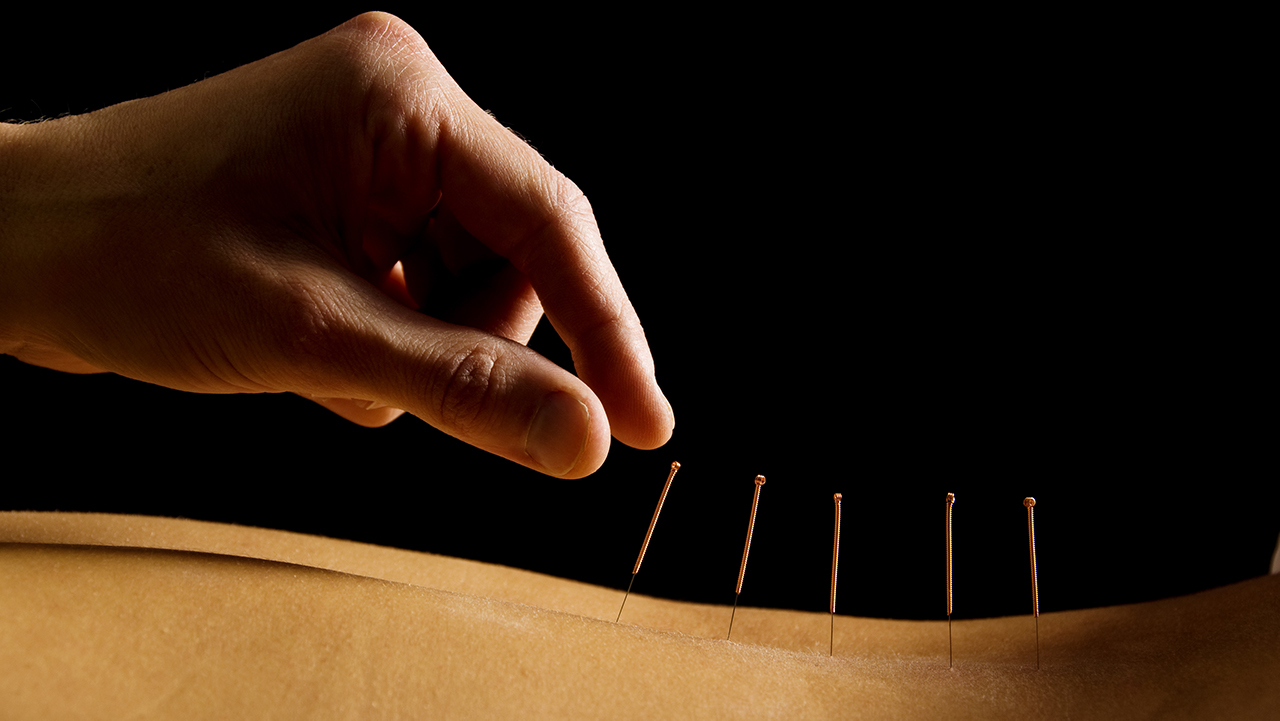 Back Acupuncture